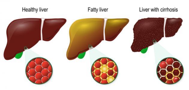 علاج تشمع الكبد - مرض مزمن 1078 2