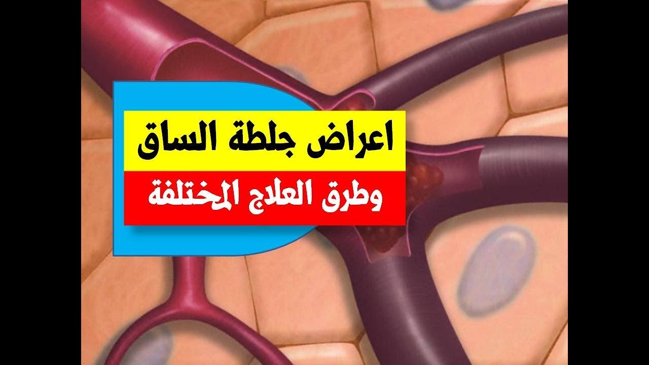 جلطه الساق وعلاجها , كيف يعالج جلطه الساق