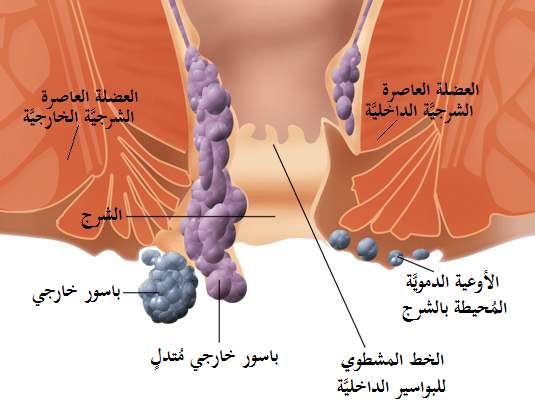 انواع البواسير والعوامل المسببة والعلاجات الدوائية والجراحية , ما هي البواسير وأعراضها وعلاجها والوقاية منها , 