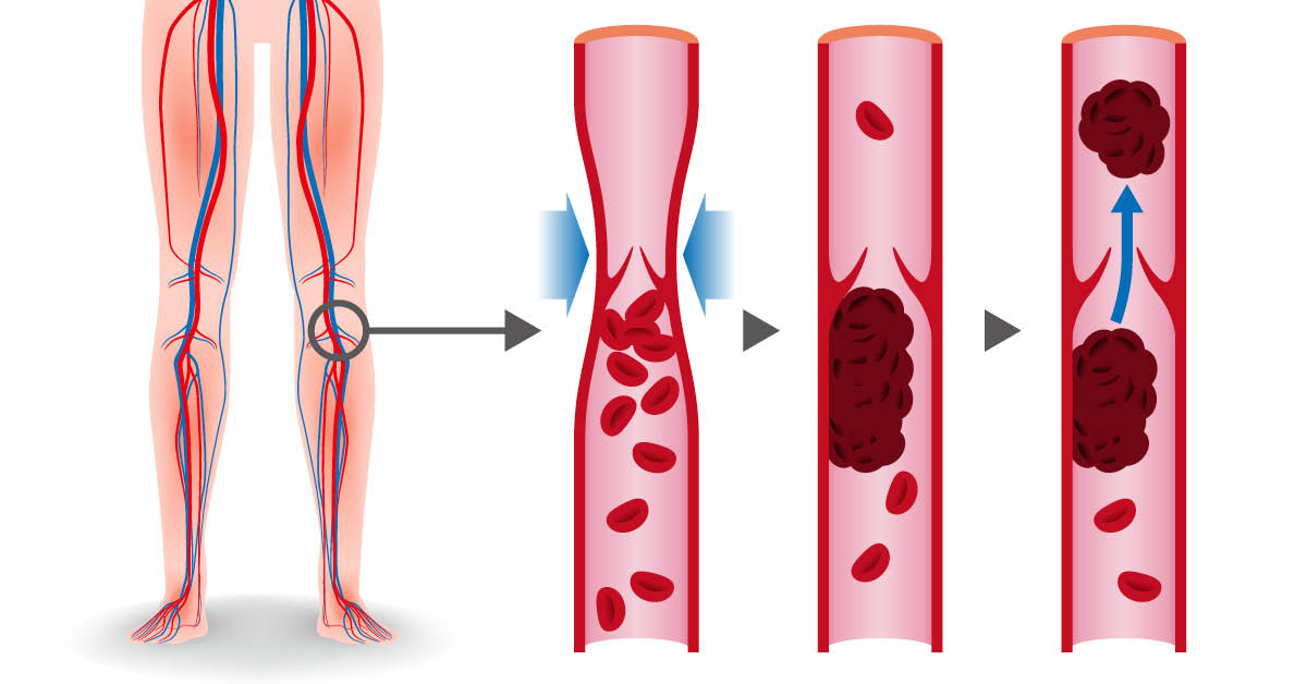 جلطه الساق وعلاجها - كيف يعالج جلطه الساق 2748 2