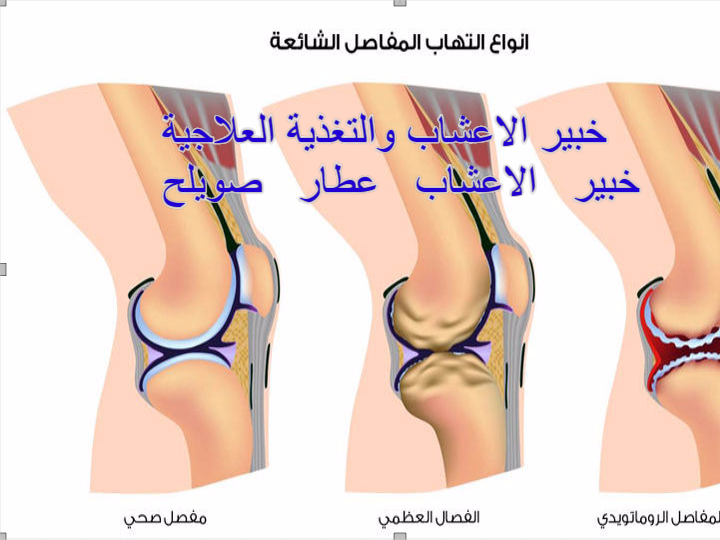 اسباب طقطقة العظام والمفاصل - اصوات يصدرها جسمك فماذا تدل 2835