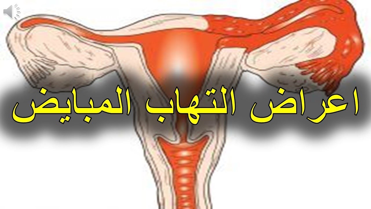 اعراض التهاب المبايض - كيف تعرفي انه يوجد التهاب في المبايض 449 3