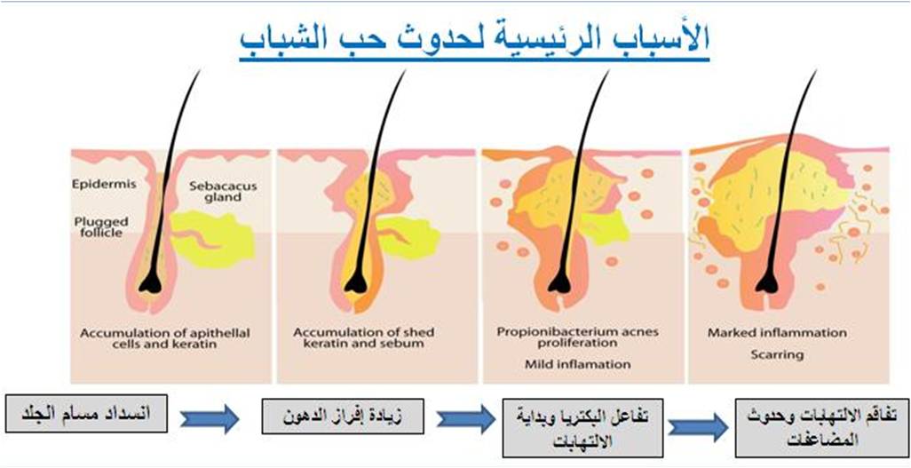 ما سبب ظهور حب الشباب , العوامل التي تساعد في وجود حب الشباب