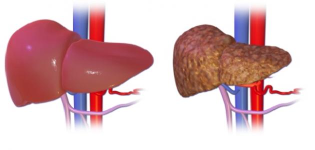 علاج تشمع الكبد - مرض مزمن 1078 1