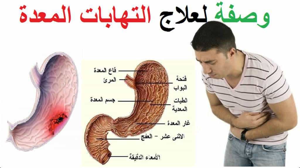 علاج التهاب راس المعدة , الطرق السليمه لعلاج الم راس المعدة