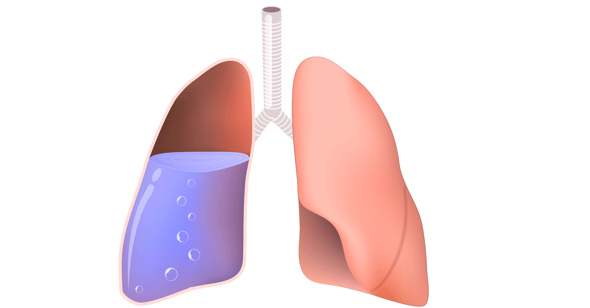 هل الماء على الرئة خطير , فما هو و السبب وراء ذلك