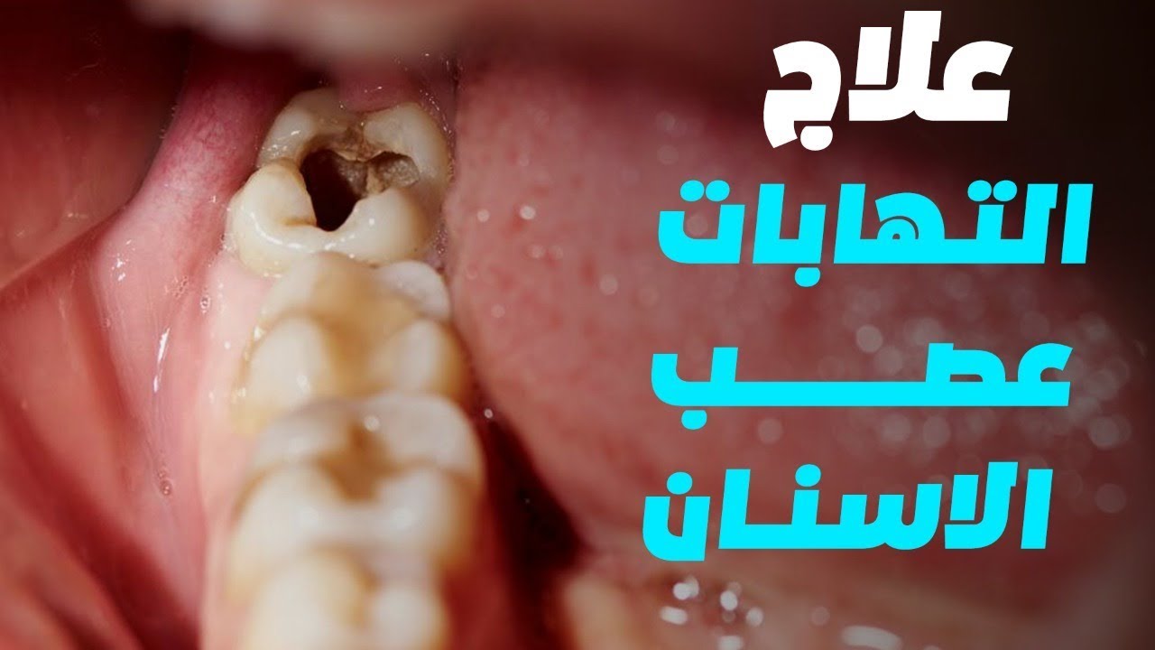 علاج التهاب عصب الضرس , هل عصب الضرس له علاج