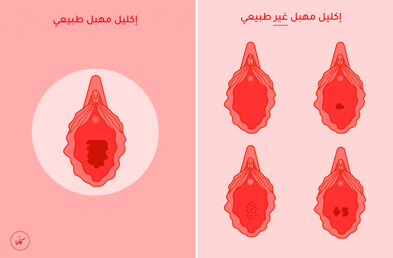 شكل فتحة المهبل - تعدد اشكال المهبل 3398