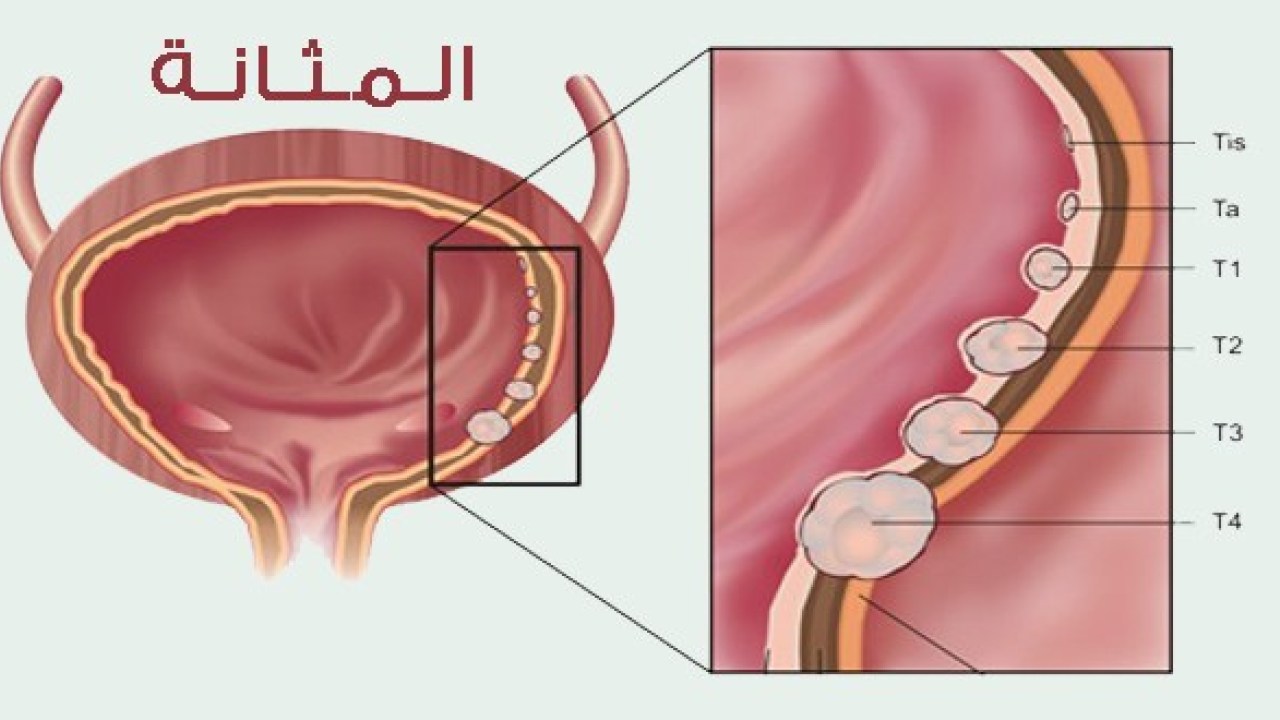 اعراض سرطان المثانة - علامات توضح لك سرطان المثانه 3025 1