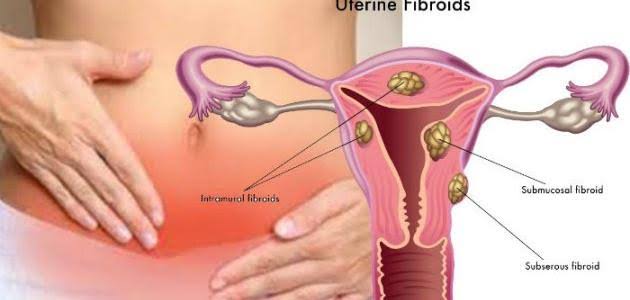 علاج الياف الرحم , مرض خطير قد تصاب به النساء بدون ان تعلم