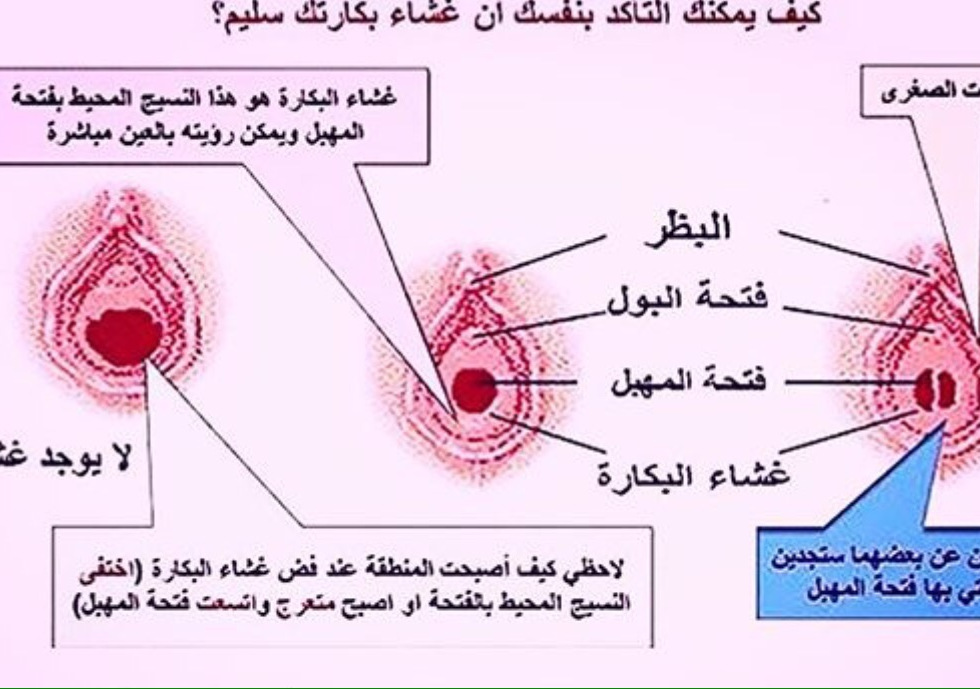 تركيب غشاء بكارة بنفسك - ما هو غشاء البكارة وانواعه 3268 1