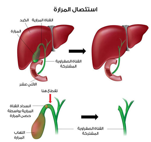 عملية ازالة المرارة , اساليب استئصال كيس المراره