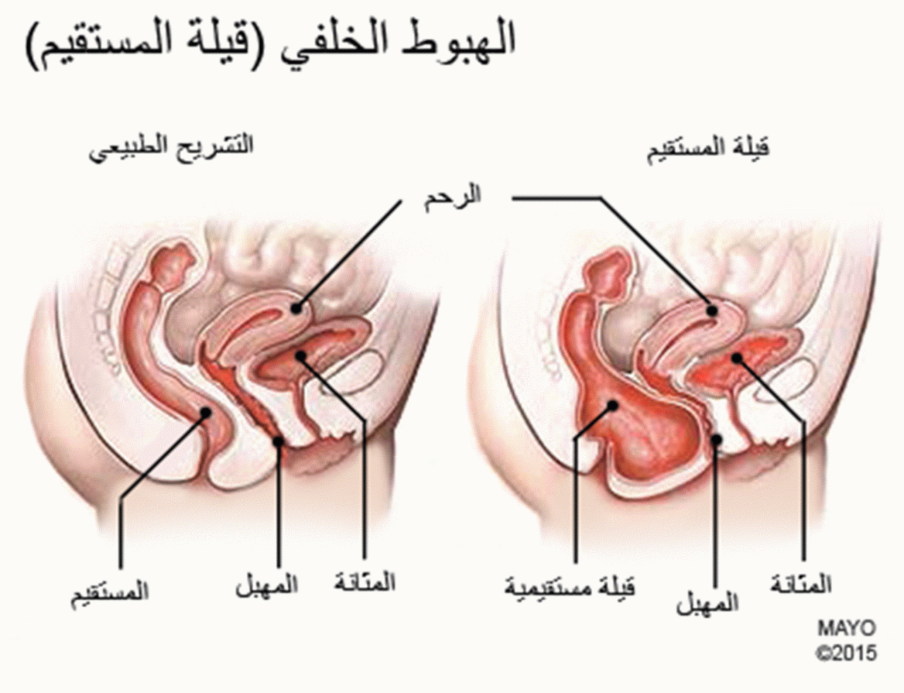 شكل فتحة المهبل - تعدد اشكال المهبل 3398