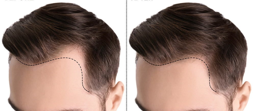 اسعار زراعة الشعر في تركيا , زراعه الشعر بسعر مخفض