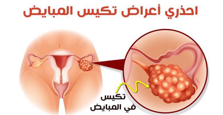 اعراض التهاب المبايض - كيف تعرفي انه يوجد التهاب في المبايض 449 2