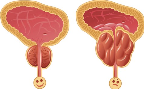 تضخم البروستاتا اسبابها وعلاجها , حل مشاكل البروستاتا