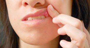 من مشاكل للتخلص علاج سريع حل حبوب الفم الشفايف 3571 3 310x165